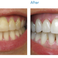 Teeth Whitening kit - before & after