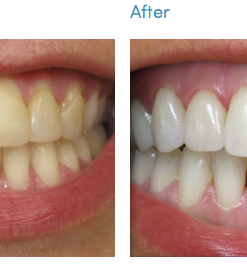 Teeth Whitening kit - before & after