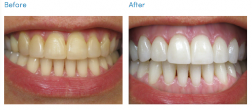 Teeth Whitening kit - before & after